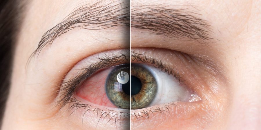 Alcoholic Eyes: Identifying and Treating Alcoholic Vision Loss